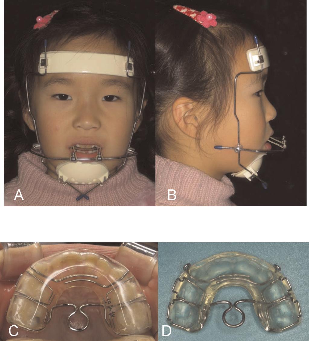694 LEE, KIM, LIM, AHN Figure 1. (A) Delaire-type face mask with elastics that delivered 350 g of maxillary protraction force on each side, 30 degrees downward from the occlusal plane.