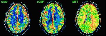 , fmri scan of a woman after a stroke w Blue/green: normal blood flow w Red/black: abnormal blood flow Very good spatial resolution