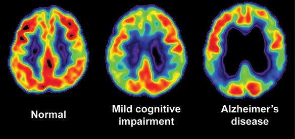 Differences We have to look for differences in activity Alzheimer s patients have reduced brain activity A simple experiment Suppose you run an fmri experiment where a