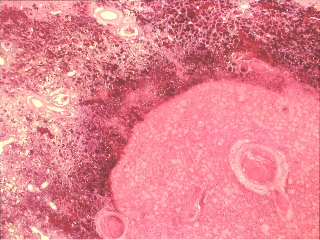 Invasive Aspergillosis in neutropenic