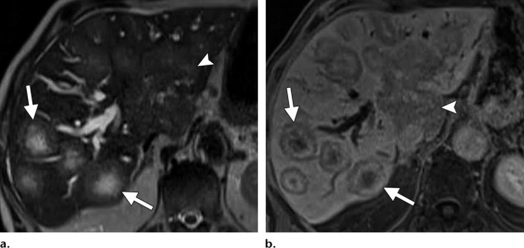 80-year-old man with large B-cell secondary hepatic lymphoma.
