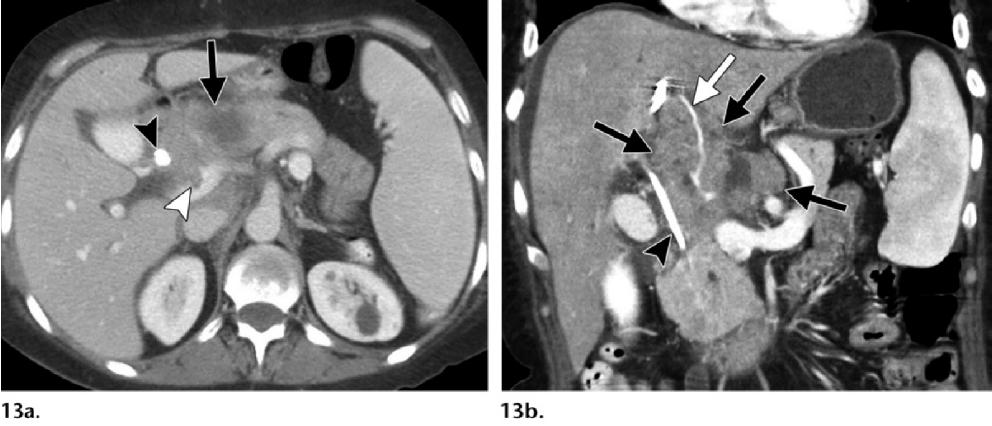 Periportal infiltrative pattern of PTLD in a 69-year-old woman with previous liver transplant who presented with abdominal pain.