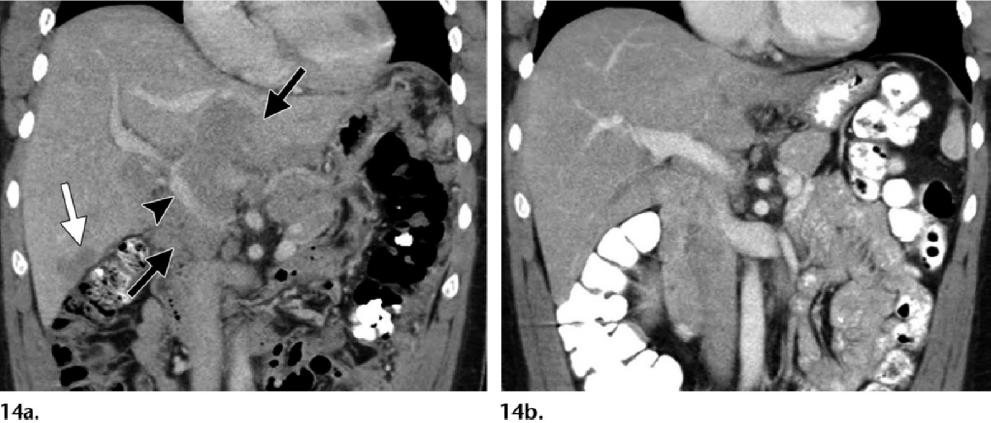 PTLD manifesting as a periportal mass in a 35-year-old man with a history of liver transplant who presented with abdominal tenderness.