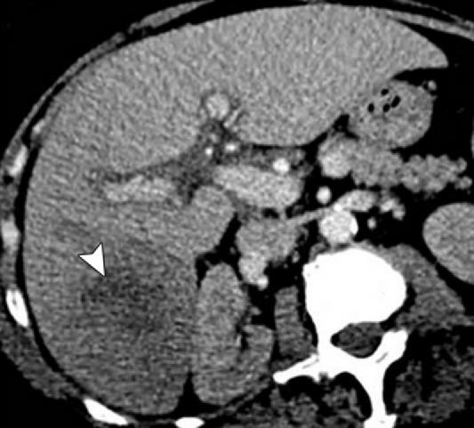 64-year-old man with myelofibrosis. Axial nonenhanced CT image shows a poorly defined hypoenhancing hepatic mass (arrowhead).