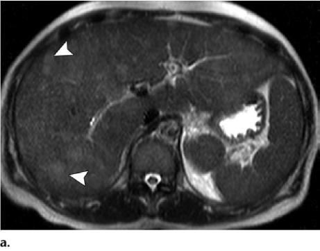 (b) Axial gadolinium-enhanced MR image does not depict the hepatic lesions.