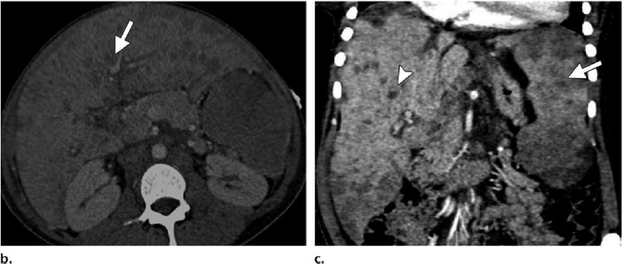 38-year-old man who presented with weight loss and flu-like illness. (b) Axial CT image shows marked hepatosplenomegaly, with numerous hypoenhancing masses (arrow).