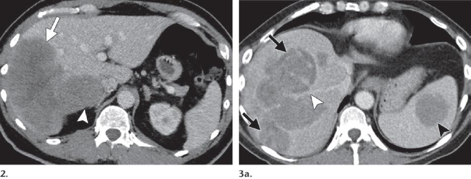 PHL in a 57-year-old man with fever and night sweats. Axial CT image shows two contiguous lesions (arrow and arrowhead) in the liver, with one lesion being dominant (arrow).
