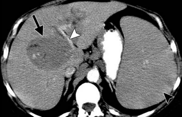 77-year-old woman with known lymphoma who presented with splenomegaly at physical examination. Axial CT image shows hepatomegaly with discrete, predominantly homogeneous, hypoenhancing masses (arrow).