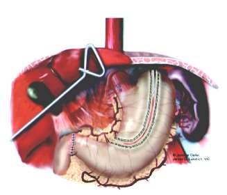 7 Abdominal Dissection Start dissection at the pars lucida and then perform hiatal dissection.