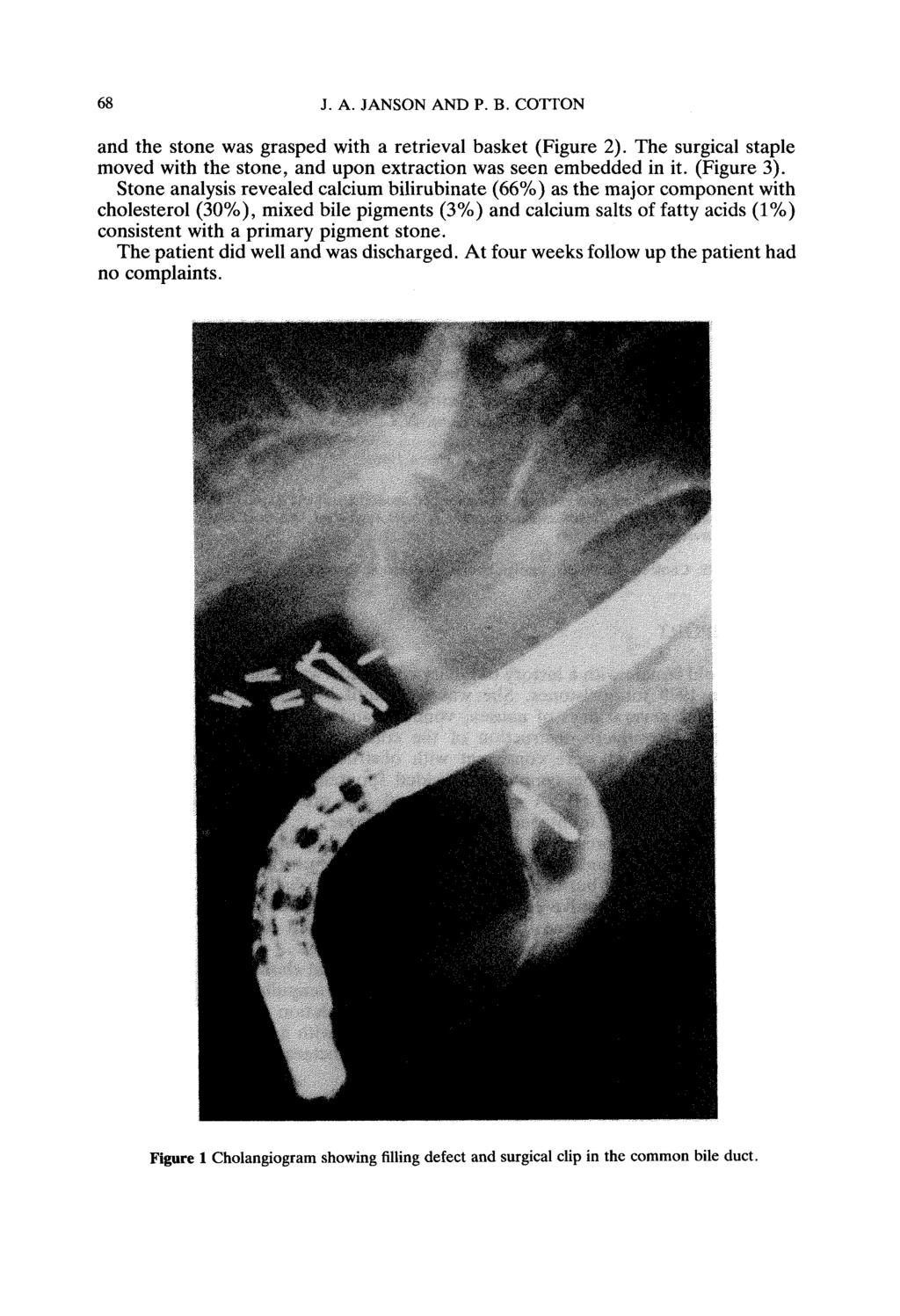 68 J.A. JANSON AND P. B. COTTON and the stone was grasped with a retrieval basket (Figure 2). The surgical staple moved with the stone, and upon extraction was seen embedded in it. (Figure 3).