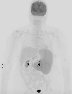 the axial skeleton no focal activity homogenous Imperative to know if this patient has received chemotherapy recently Bone Marrow