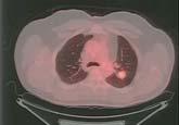 metastasis Diffuse Head and neck Chest Abdomen and Pelvis Tumors with low uptake Lung Non-lung primaries lung nodule discovered on CXR