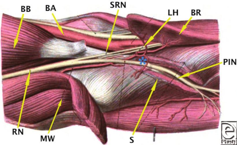 Figure 4. Diagrammatic representation of the branches of the radial nerve as it courses distal to the elbow. Adapted from Ref 1.