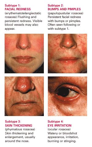 Acne Rosacea inflammatory aggravated by vasodilators: wine, vinegar, spices aggravated by