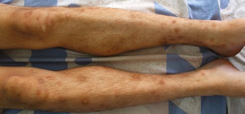 Pneumologia REVISTA SOCIETĂŢII ROMÂNE DE PNEUMOLOGIE Figure 1. A, B - postinflammatory hyperpigmentation after insect bites manifested as darkly-pigmented macules on the legs.