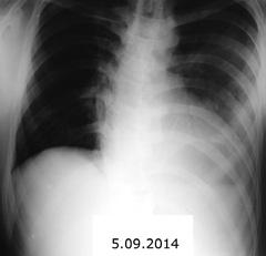 CLINICAL CASES Figure 2. A posteroanterior chest X-ray shows extensive opacification of nearly entire left lung that gradually diminishes upward with Felson sign and aeric bronchograms.