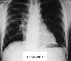 Pneumologia REVISTA SOCIETĂŢII ROMÂNE DE PNEUMOLOGIE Figure 3. Chest radiographs confirming recurrent pneumonias with variable lobar distribution in the previous years than in France (5.