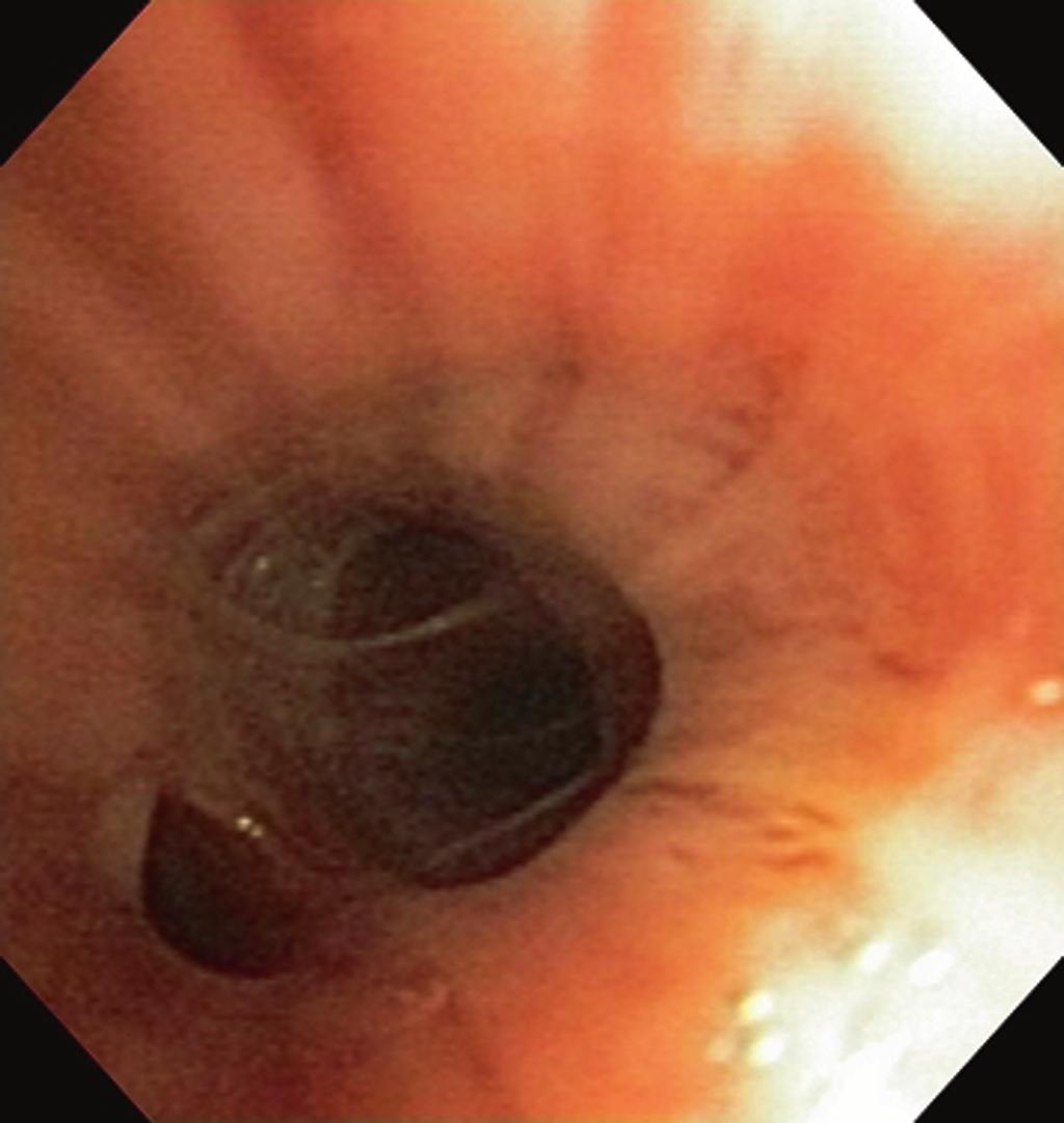 22 Gorden Fig. 2.9. Bronchoscopy performed from the head of the bed with the patient supine. Right lower lobe segments. At the 8 o clock position is the entrance to the medial basilar segment.