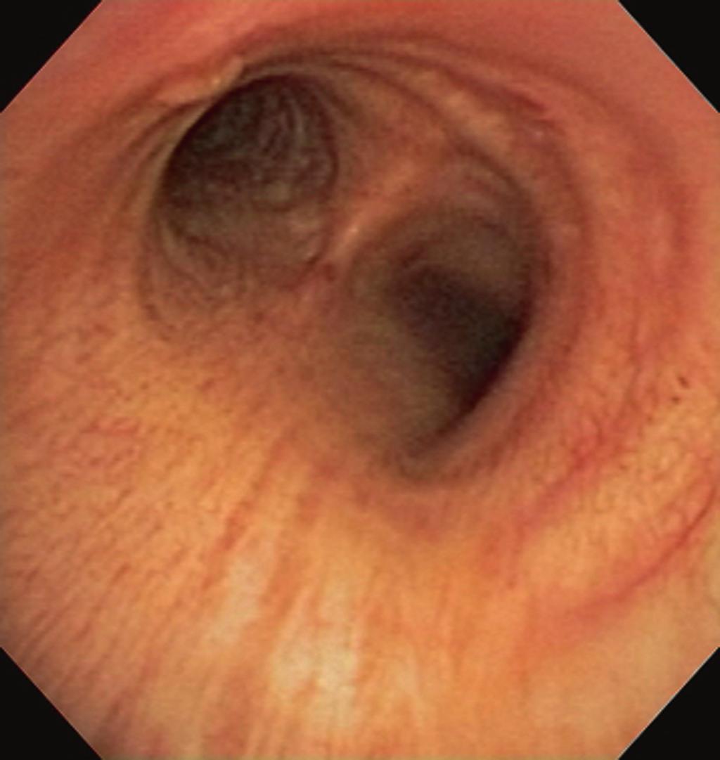 18 Gorden Fig. 2.5. Bronchoscopy performed from the head of the bed with the patient supine. This view is of the distal trachea with the main carina in view.