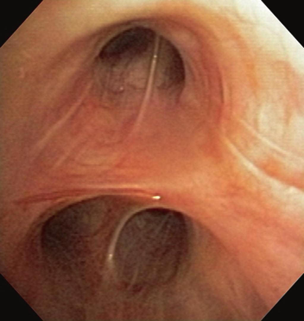 20 Gorden Fig. 2.7. Bronchoscopy performed from the head of the bed with the patient supine. The trifurcation of the right upper lobe is illustrated in this image.