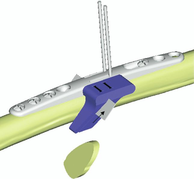 ) FIGURE 3: Osteotomy guides attached directly to the plate. This eliminates the need for freehand parallel cuts. The saw placed through the guide slot is marked with an arrow.