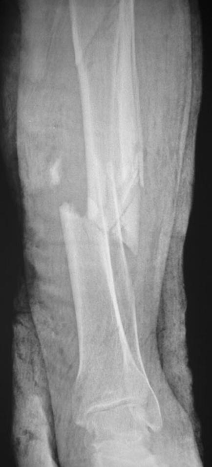 Strat Traum Limb Recon (2013) 8:127 131 129 Fig. 4 Preoperative radiograph of the fractured left tibia did not experience refracture, infection, or permanent pain.