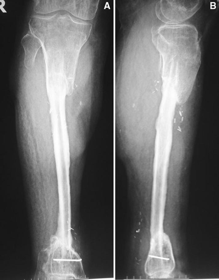 130 Strat Traum Limb Recon (2013) 8:127 131 Fig. 6 a, b Radiographs obtained 2 years after surgery show that the transferred fibula has been fully consolidated to allow full weight bearing.