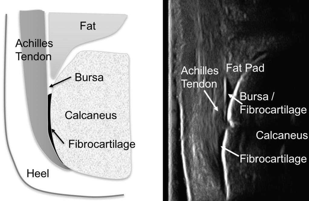 Enthesis Organ Components: Tendon Various portions of fibrocartilage Sub-tendinous bursae Fat Insertion of the