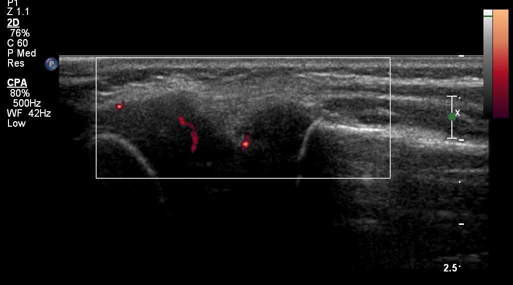 Lateral Elbow Normal PDI CET Longitudinal PDI of