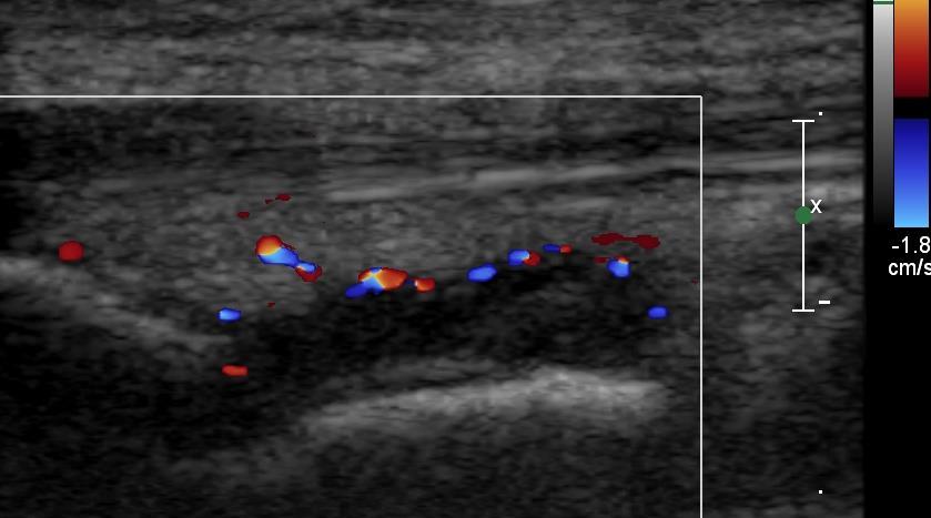 Synovitis OMERACT definitions Synovial thickening may not represent ongoing disease Doppler