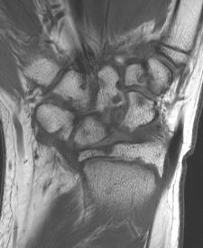 13 year-old, without arthritis 11 year-old,