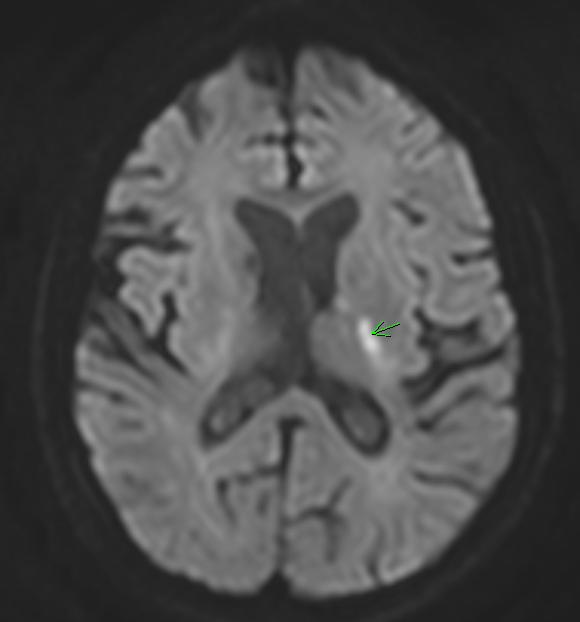 Small Vessel Disease Cause of small subcortical or lacunar strokes Mechanism of stroke Occlusion of small deep penetrating end-arteries Related to lipohyalinosis and microatheroma formation May have