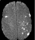 Case 2 IAT is successful, and symptoms improve rapidly to NIHSS 2. MRI shows embolic appearing stroke in left MCA distribution as well as small stroke in right MCA distribution.
