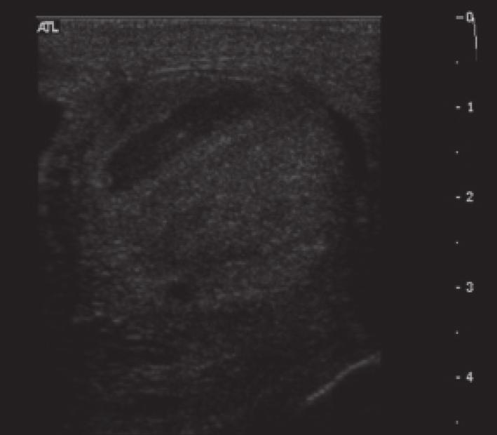 2 Case Reports in Radiology (a) (b) (c) Figure 1: Multiple axial and longitudinal sonographic images (a c) of the left testicle with