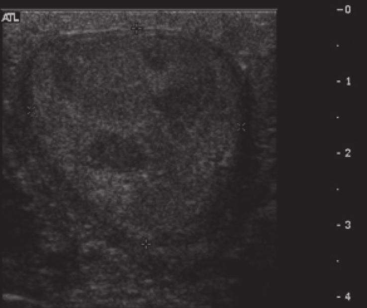 the majority of the testis. The right testis (image not provided) had a similar appearance.
