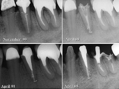 The antibacterial effects of s in endodontics Author_Dr Selma Cristina Cury Camargo, Brazil Fig. 1_Success in endodontic treatment: apical radiolucency repair. Fig. 1 _Endodontic infection The success of endodontic treatment reaches values between 85 to 97 per cent.