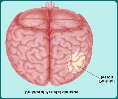Balint s Syndrome Balint s syndrome also results from lesions to posterior parietal lobe, or at the parieto-occipital junction.