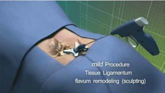 11. The mild Portal may be positioned at various angles relative to the lamina and interlaminar space to enable the Tissue Sculpter to select tissue for resection.
