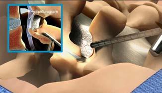 Advance the Tissue Sculpter tip into the interlaminar space and direct the tip toward the ventral aspect of the adjacent superior lamina to capture ligamentous and fatty tissue. 13.