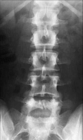 Note: Lumbar AP projection reveals the interlaminar space and bony landmarks to guide mild procedure.