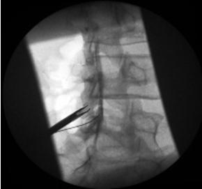 filled with contrast Note: The Contralateral oblique projection reveals the posterior to anterior plane with contrast mediamarked epidural space and the position of mild Tissue Sculpter tip relative