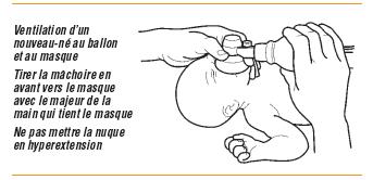 Ventilating a neonate with bag and mask Pull the jaw forward towards the mask with the