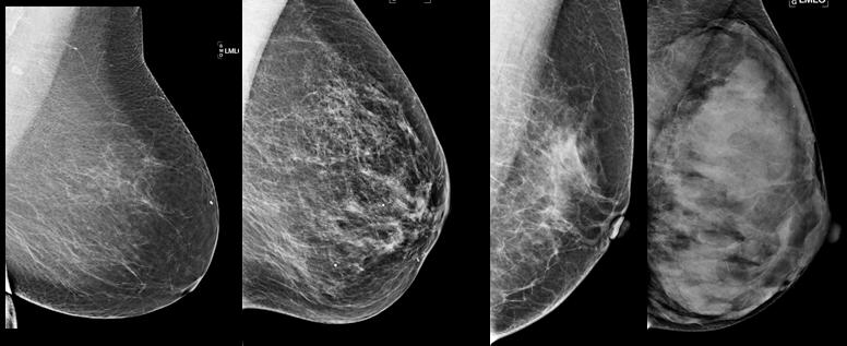 Spectrum of breast density Predominantly Fatty Scattered Areas Heterogeneously Dense
