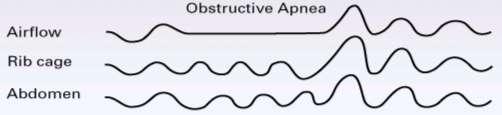 Obstructive Sleep Apnea OSA is described as repetitive episodes of complete or partial upper airway obstruction during
