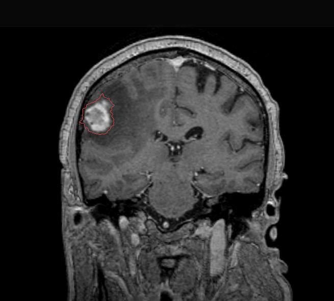 StereotacJc irradiajon MulJple fixed field stereotacjc radiosurgery 22 Role of whole brain RT Survival