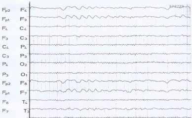 EEG-u Slika 6.
