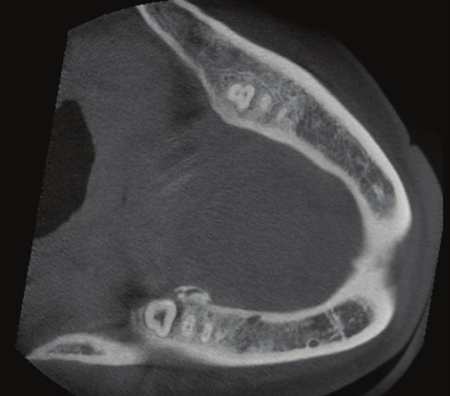 CBCT donje čeljusti pokazuje dubok parodontni džep između drugoga i trećega donjeg desnog molara