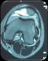 Absolute Surgical Indications 1. Osteochondral fragment 2. Irreducible dislocation 3.