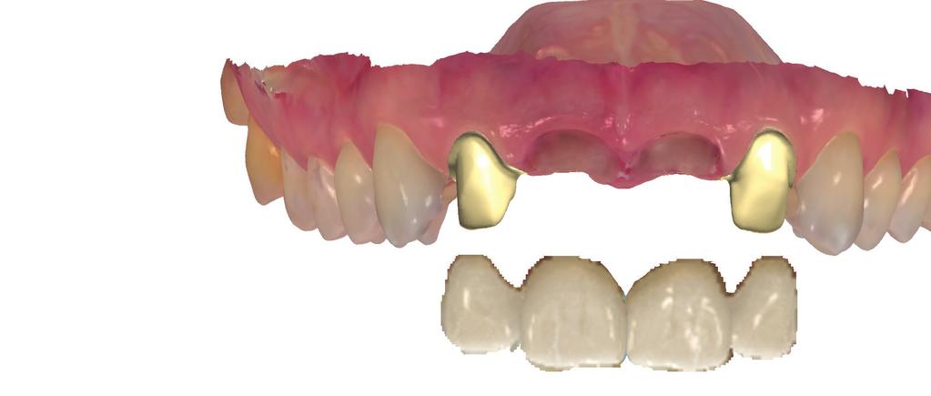 Temporary crowns and virtual diagnostic wax-ups Scan the