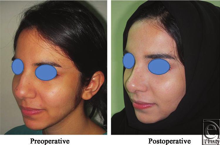 eplasty VOLUME 13 Figure 4. Left oblique view photo for the same patient Fig 2 before and after open primary rhinoplasty. Figure 5.